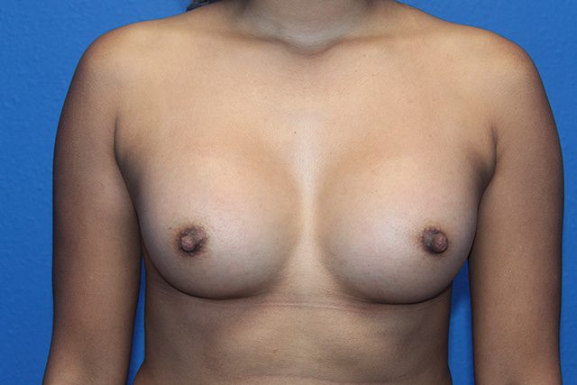 BREAST AUGMENTATION PATIENT 23 View 1 - After Thumbnail