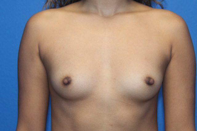 BREAST AUGMENTATION PATIENT 23 View 1 - Before Thumbnail