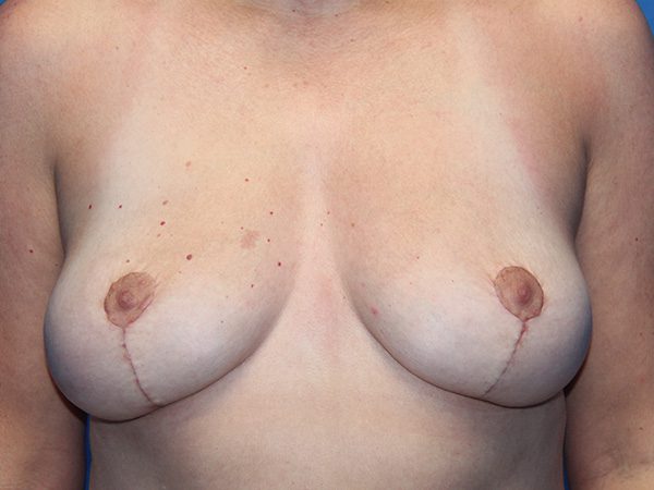 BREAST IMPLANT REMOVAL AND BREAST LIFT PATIENT 11 View 1 - After Thumbnail