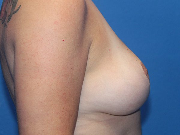 BREAST IMPLANT REMOVAL AND BREAST LIFT PATIENT 11 View 2 - After Thumbnail