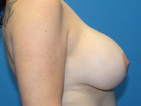 BREAST IMPLANT REMOVAL AND BREAST LIFT PATIENT 11 View 2 - Before Thumbnail