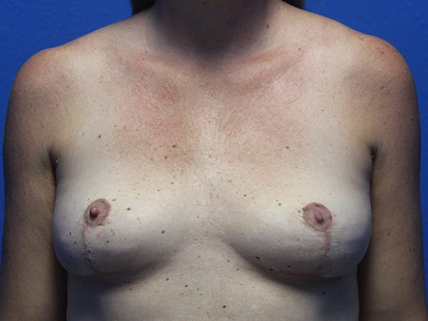 BREAST IMPLANT REMOVAL AND BREAST LIFT PATIENT 12 View 1 - After Thumbnail