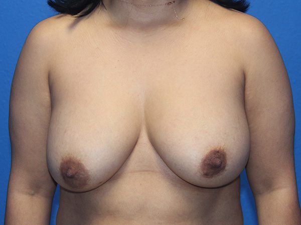 BREAST IMPLANT REMOVAL AND BREAST LIFT PATIENT 09 View 1 - Before