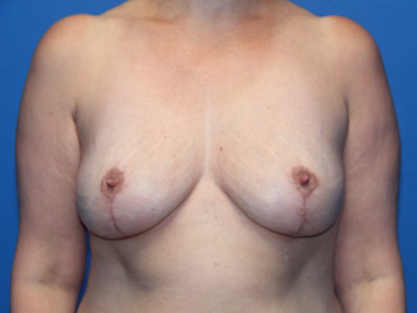 BREAST IMPLANT REMOVAL AND BREAST LIFT PATIENT 10 View 1 - After Thumbnail