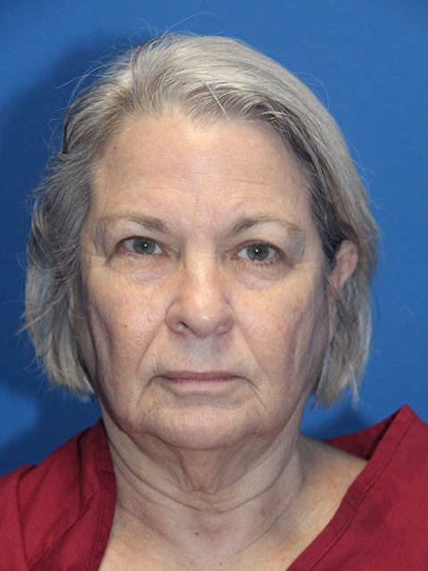 FACELIFT PATIENT 12 View 1 - Before