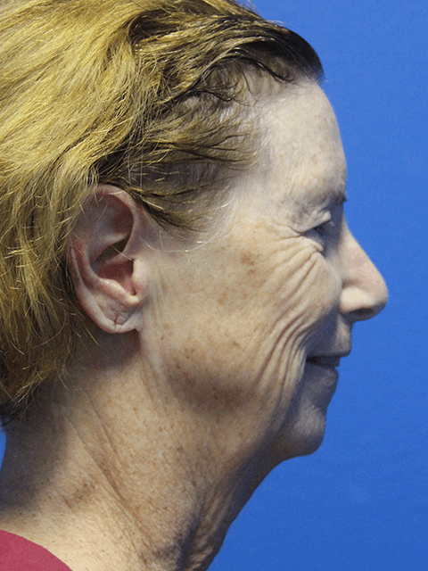 FACELIFT PATIENT 15 View 2 - Before Thumbnail