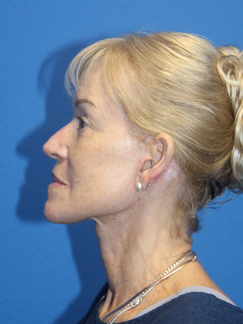 Facelift Patient 14 View 2 - After Thumbnail