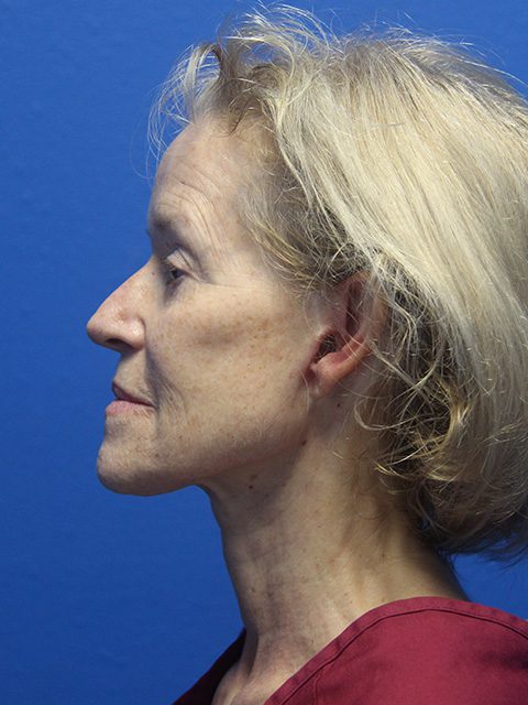 Facelift Patient 14 View 2 - Before Thumbnail