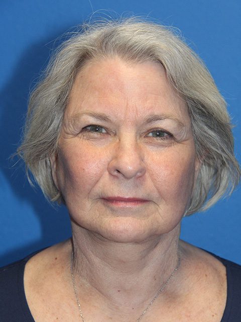 FACELIFT PATIENT 12 View 1 - After