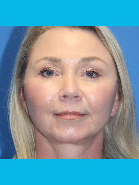 FACELIFT PATIENT 11 View 1 - After