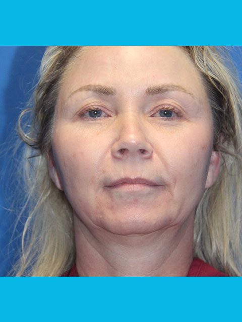 FACELIFT PATIENT 11 View 1 - Before