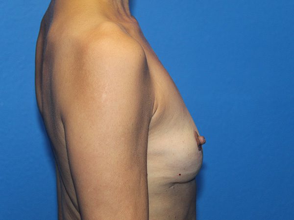 BREAST IMPLANT REMOVAL AND BREAST LIFT PATIENT 08 View 2 - After Thumbnail