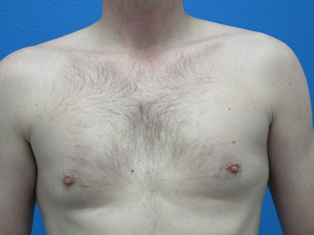 PECTORAL IMPLANTS PATIENT 02 View 1 - Before Thumbnail