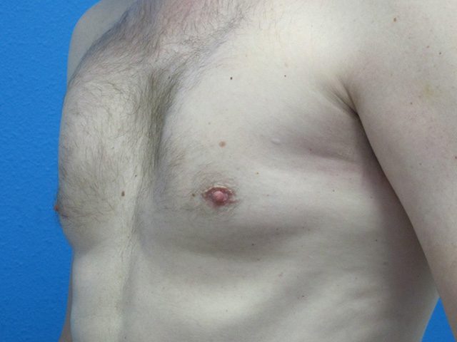 PECTORAL IMPLANTS PATIENT 02 View 2 - Before Thumbnail