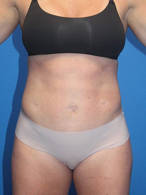 TUMMY TUCK PATIENT 12 View 1 - After Thumbnail
