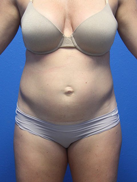 TUMMY TUCK PATIENT 12 View 1 - Before Thumbnail