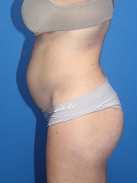 TUMMY TUCK PATIENT 12 View 2 - Before Thumbnail