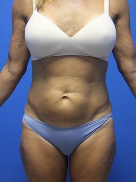 TUMMY TUCK PATIENT 13 View 1 - Before Thumbnail