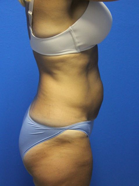 TUMMY TUCK PATIENT 13 View 2 - Before Thumbnail