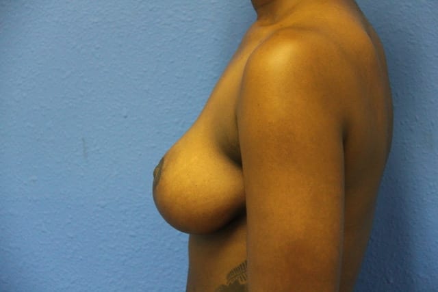 Case--7905 | After Breast Reduction 5