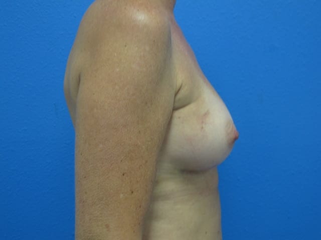 Case--2441 | After Breast Reconstruction with Fat Transfer 1