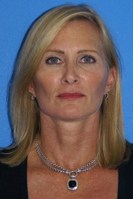 Case--9218 | After Brow Lift 1