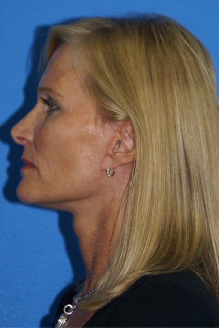 Case--9218 | After Brow Lift 3