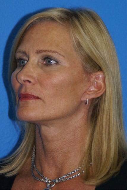 Case--9218 | After Brow Lift 4