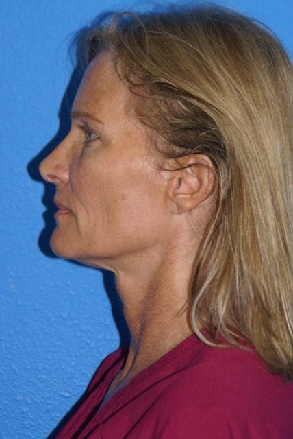 Case--9218 | Before Brow Lift 3