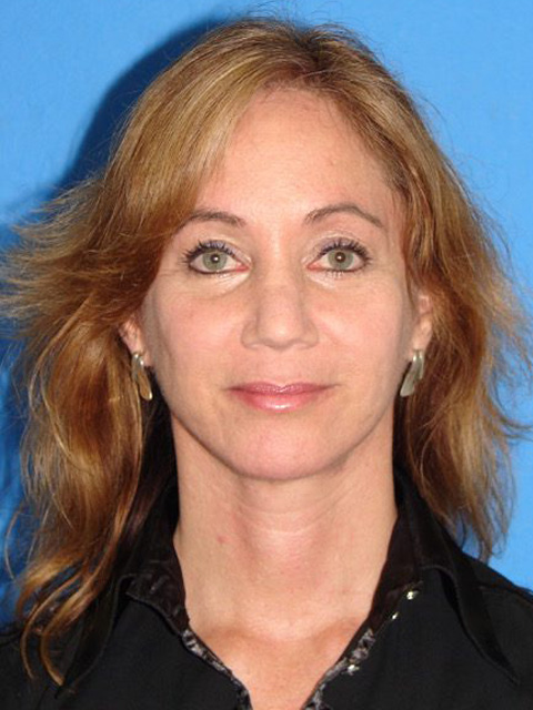 Case--9730 | After Eyelid Surgery / Blepharoplasty 1