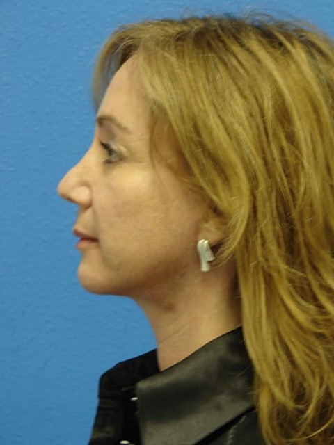 Case--9730 | After Eyelid Surgery / Blepharoplasty 2