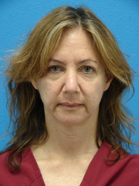 Case--9730 | Before Eyelid Surgery / Blepharoplasty 1