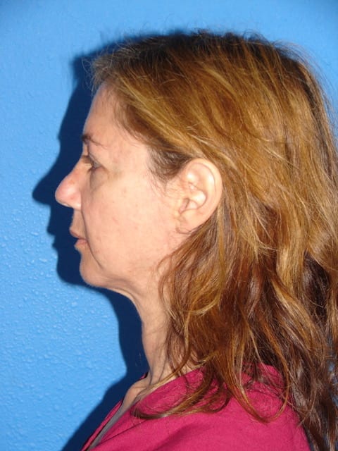 Case--9730 | Before Eyelid Surgery / Blepharoplasty 2