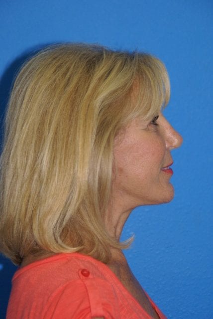 Case--2085 | After Cheek Lift 2