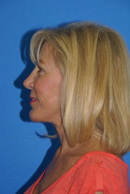 Case--2085 | After Cheek Lift 4