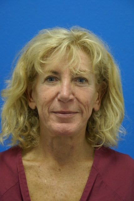 Case--2085 | Before Cheek Lift 1