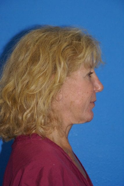 Case--2085 | Before Cheek Lift 2
