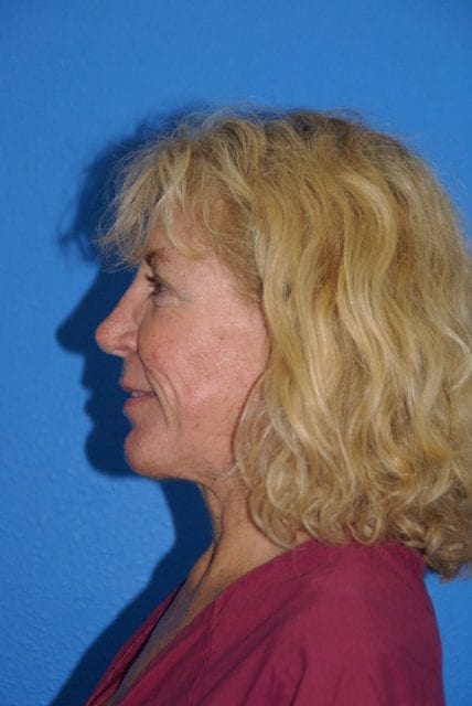 Case--2085 | Before Cheek Lift 4