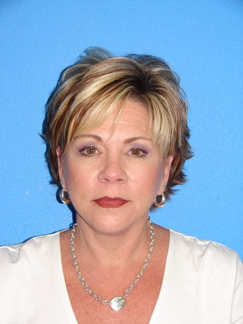 Case--3657 | After Eyelid Surgery / Blepharoplasty 1
