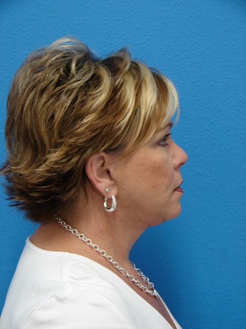 Case--3657 | After Eyelid Surgery / Blepharoplasty 2