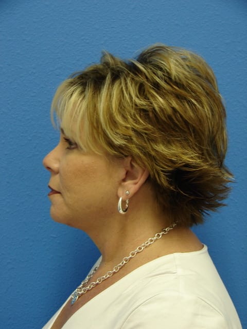 Case--3657 | After Eyelid Surgery / Blepharoplasty 3