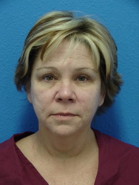 Case--3657 | Before Eyelid Surgery / Blepharoplasty 1