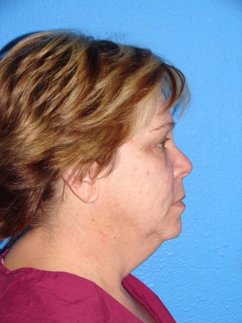 Case--3657 | Before Eyelid Surgery / Blepharoplasty 2