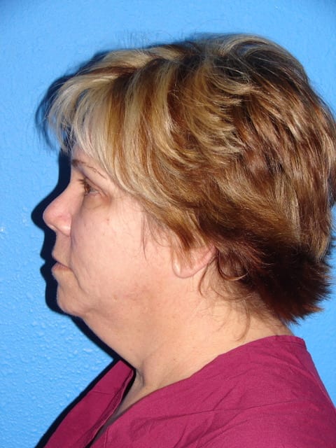 Case--3657 | Before Eyelid Surgery / Blepharoplasty 3