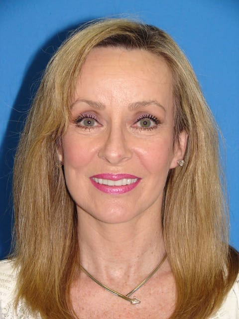 Case--6726 | After Eyelid Surgery / Blepharoplasty 1