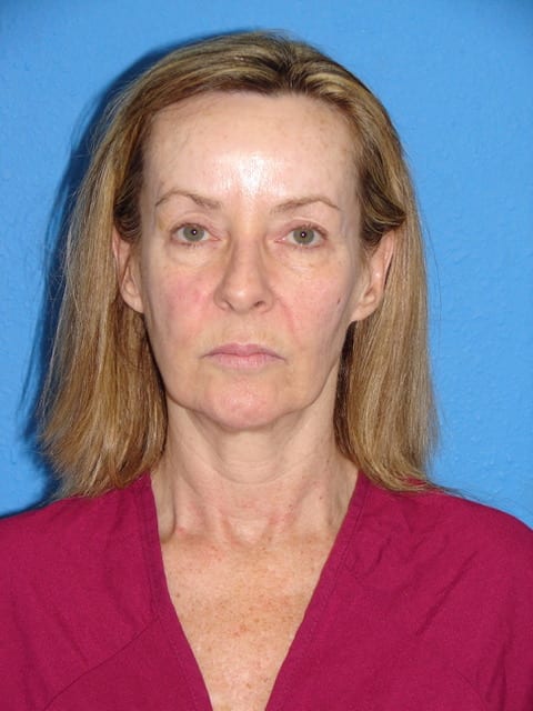 Case--6726 | Before Eyelid Surgery / Blepharoplasty 1