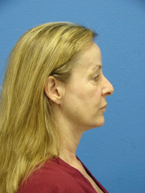 Case--6726 | Before Eyelid Surgery / Blepharoplasty 2