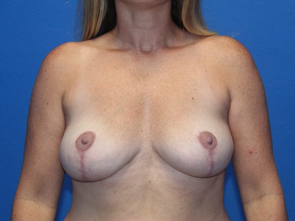 Case--2552 | After Breast Implant Removal and Breast Lift 1