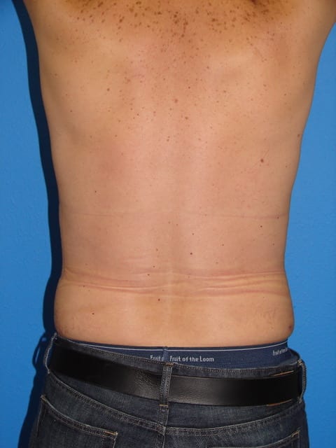 Case--2862 | After Male Liposuction 3