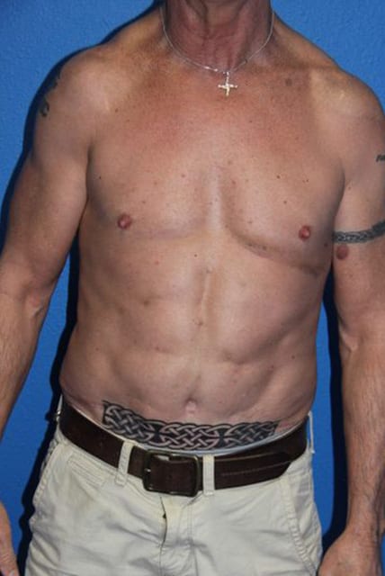 Case--4051 | After Male Liposuction 1
